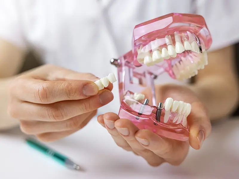 Anschauungsmaterial in Händen Zahnarzt Implantat in Heidelberg